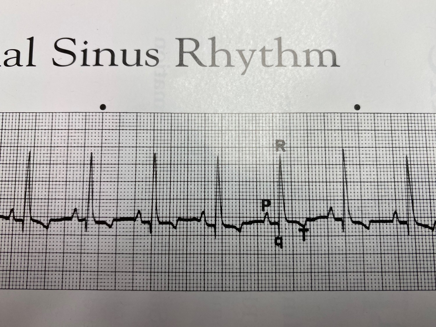 ecg photo